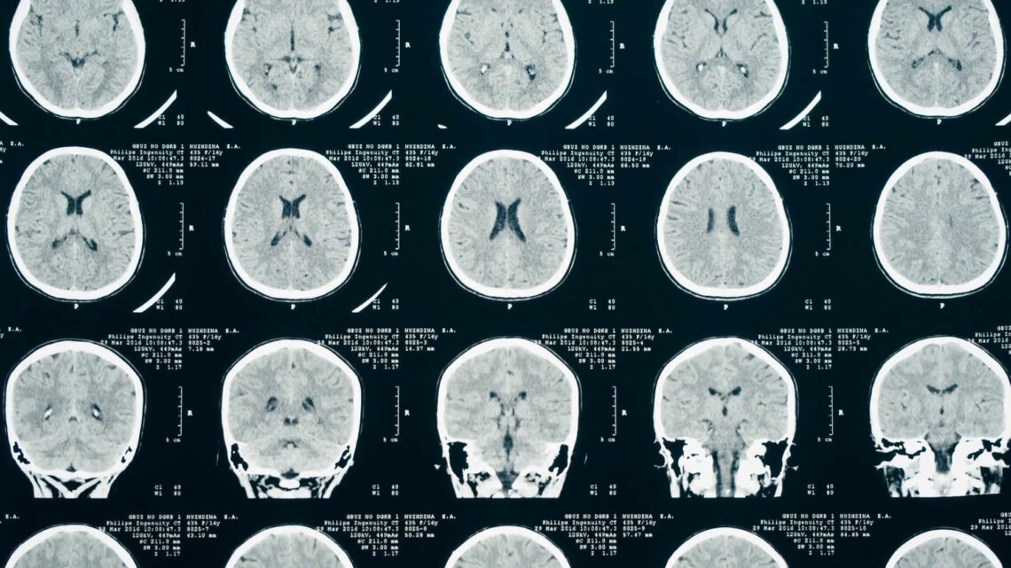 L’intelligenza artificiale per ottimizzare la Tac L’intelligenza artificiale per ottimizzare la Tac