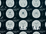 L’intelligenza artificiale per ottimizzare la Tac