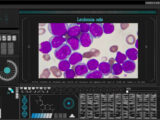Un nuovo strumento per predire il rischio di leucemia