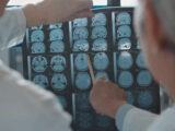 Alzheimer, terapie allo studio per rallentare il decorso
