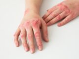 Salutequità e Apiafco “La psoriasi entri nel Piano Nazionale Cronicità”