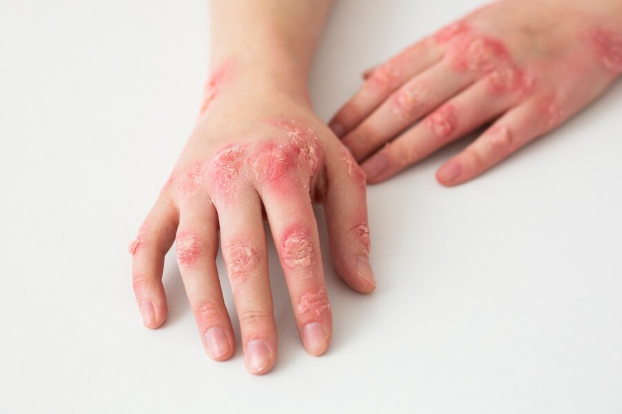 Salutequità e Apiafco “La psoriasi entri nel Piano Nazionale Cronicità” Salutequità e Apiafco “La psoriasi entri nel Piano Nazionale Cronicità”