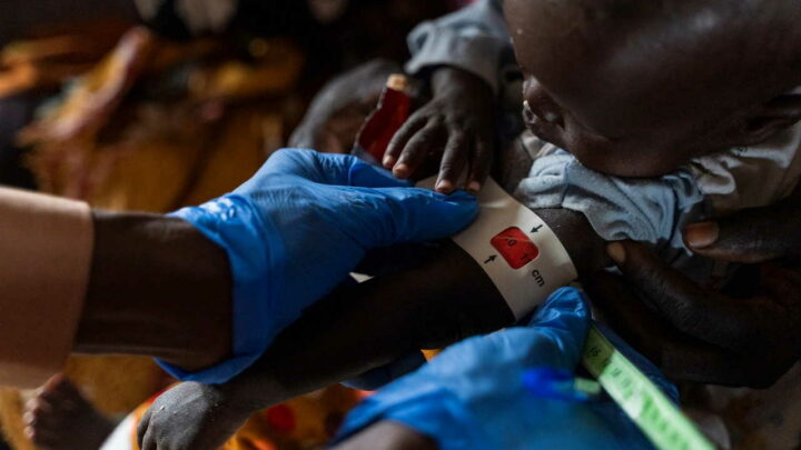 Allarme sanitario in Sudan, UNHCR e OMS: 1.200 bambini morti per morbillo e malnutrizione