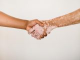 Malattie della pelle, Salutequità “Più programmazione e reti dedicate”
