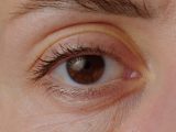 Malattie della retina, lo screening per scongiurare danni più gravi