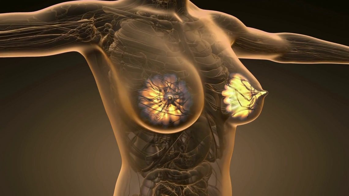 Il ruolo dei linfociti T nel carcinoma mammario Il ruolo dei linfociti T nel carcinoma mammario